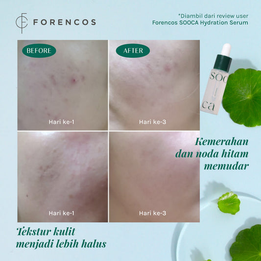 Forencos Sooca Starter Set - Trial Kit Untuk Kulit Sensitif