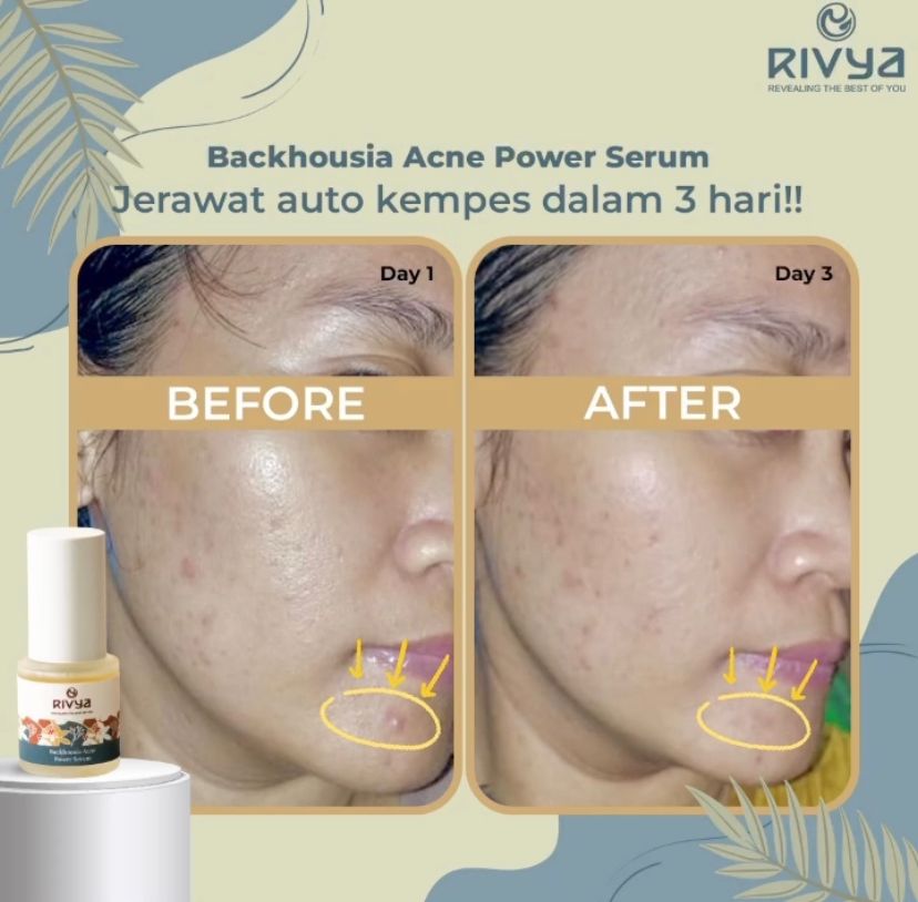 Rivya Backhousia Acne Power Serum | 20 ml