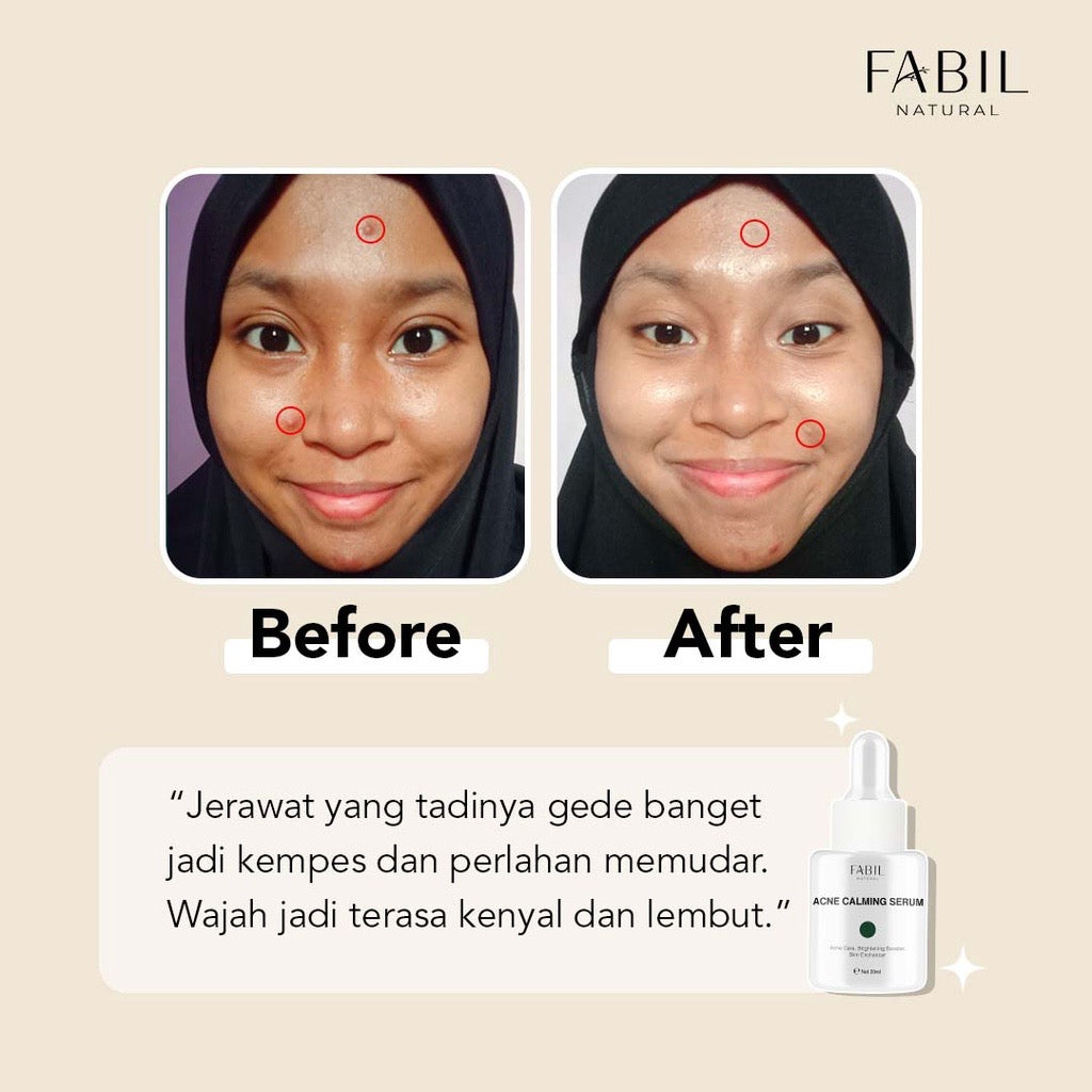 FABIL Acne Calming Serum 20ml