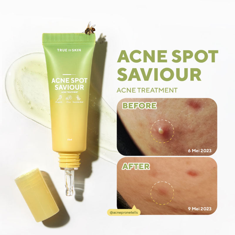 True To Skin Acne Spot Saviour | 15 ml