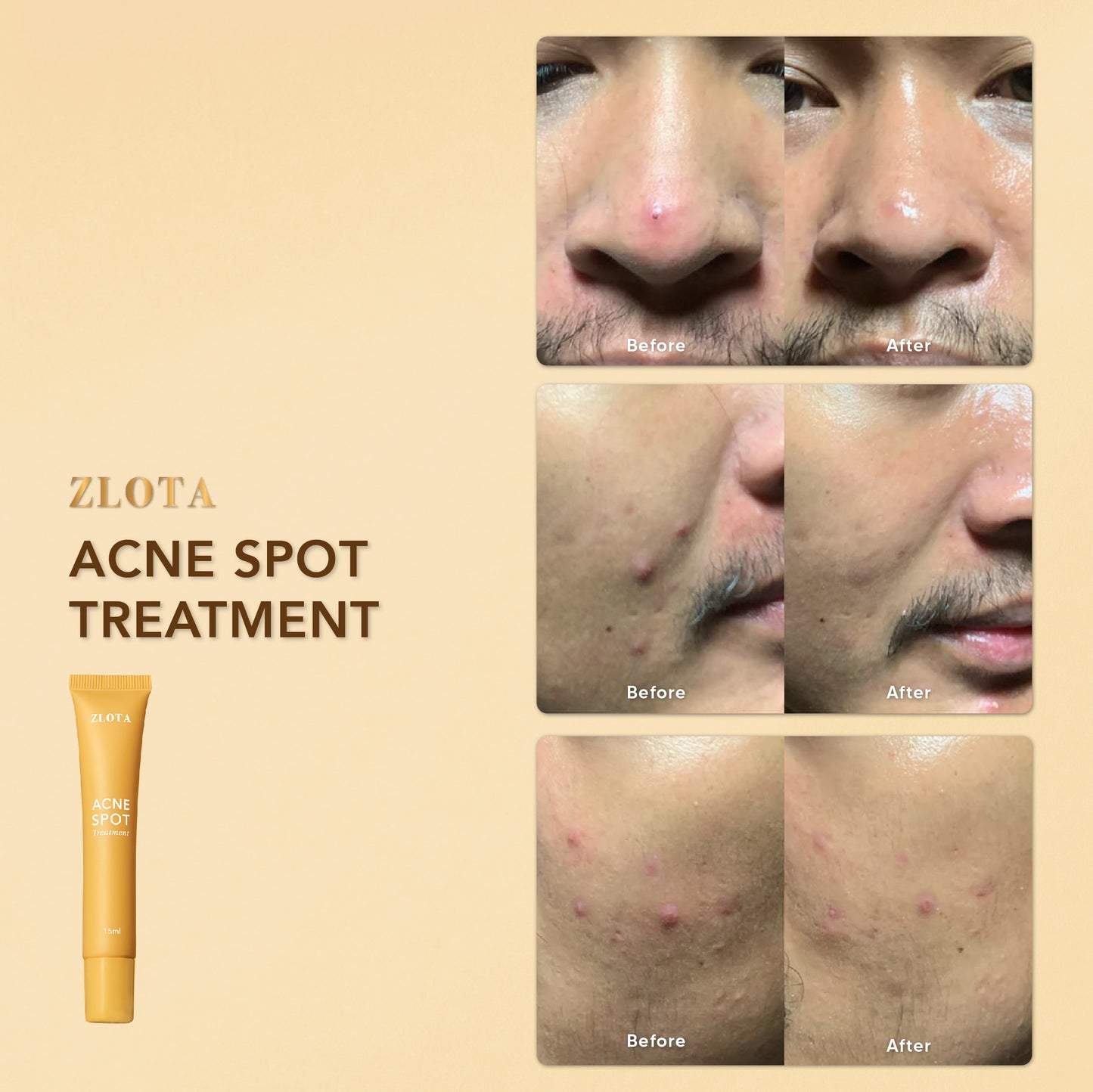 ZLOTA Acne Spot Treatment 20g