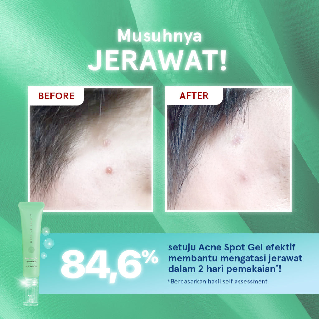 Dear Me Beauty Acne Series - Acne Spot Gel